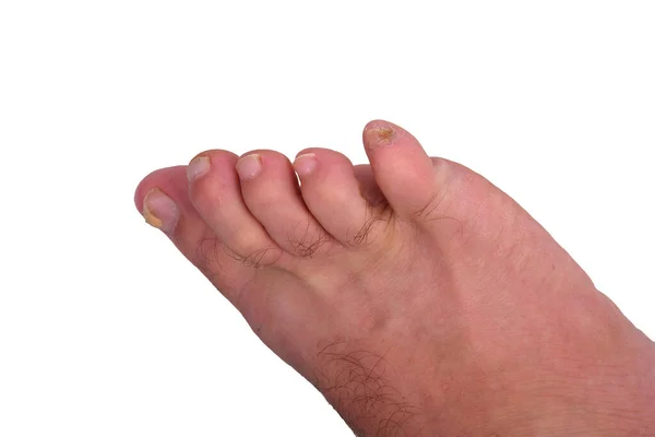 Инфекция Грибка Ногтей Большом Пальце Грибковая Инфекция Пальцах Ног Ногтей — стоковое фото