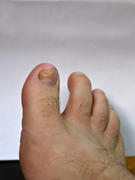 disease Fungal nail infection on the big toe. Fungal infection on toenails with mycosis onychomycosis, result of bacterial disease