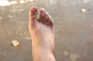 Baş parmağındaki tırnaklarda mantar enfeksiyonu var. Mantar enfeksiyonu ve mantar mantarı onikomikozis, hastalık kuru deri enfeksiyonuna neden olur.