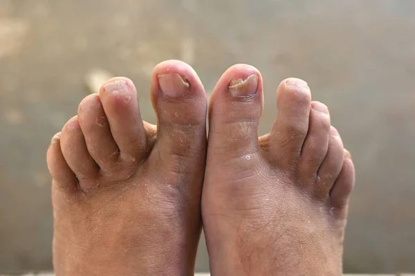 ringworm Fungal infection of the nails on the big toe. Fungal infection of toenails with ringworm onychomycosis, disease result dry skin infection heat
