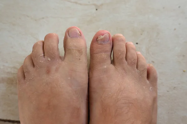 ringworm Fungal infection of the nails on the big toe. Fungal infection of toenails with ringworm onychomycosis, disease result dry skin infection heat
