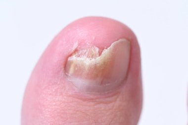 Ayak tırnaklarında mikoz mantarı enfeksiyonu var. Mantar enfeksiyonu, mantar mantarı, onikositoz, kuru cilt enfeksiyonu, tıbbi hastalıklar.