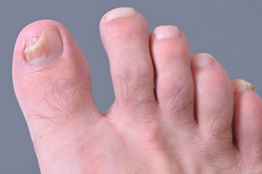 Ayak tırnaklarında mikoz mantarı enfeksiyonu var. Mantar enfeksiyonu, mantar mantarı, onikositoz, kuru cilt enfeksiyonu, tıbbi hastalıklar.