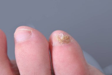 Ayak tırnaklarında mikoz mantarı enfeksiyonu var. Mantar enfeksiyonu, mantar mantarı, onikositoz, kuru cilt enfeksiyonu, tıbbi hastalıklar.