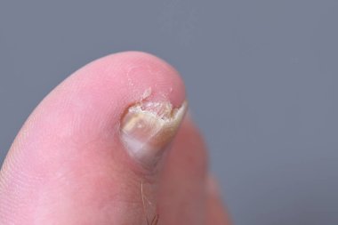 Ayak tırnaklarında mikoz mantarı enfeksiyonu var. Mantar enfeksiyonu, mantar mantarı, onikositoz, kuru cilt enfeksiyonu, tıbbi hastalıklar.