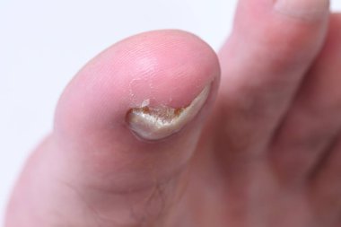 Ayak tırnaklarında mikoz mantarı enfeksiyonu var. Mantar enfeksiyonu, mantar mantarı, onikositoz, kuru cilt enfeksiyonu, tıbbi hastalıklar.