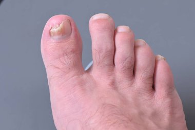 Ayak tırnaklarında mikoz mantarı enfeksiyonu var. Mantar enfeksiyonu, mantar mantarı, onikositoz, kuru cilt enfeksiyonu, tıbbi hastalıklar.