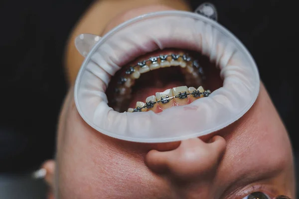 Ортодонтичне Лікування Зубів Крупним Планом Жіночі Зуби Брекетами Лікар Встановлює — стокове фото