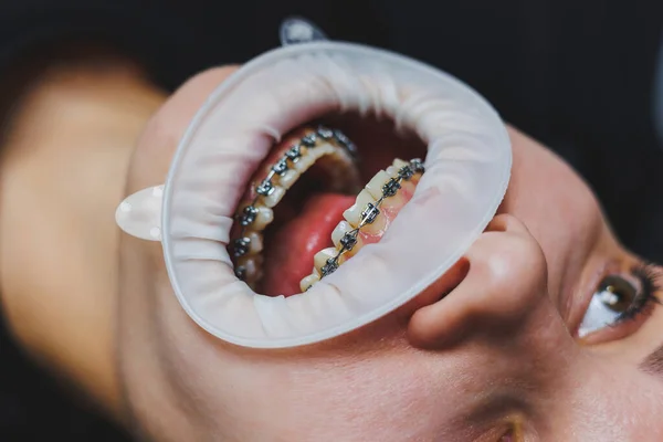 Ortodontyczne Leczenie Zębów Zbliżenie Żeńskich Zębów Aparatem Zęby Lekarz Instaluje — Zdjęcie stockowe