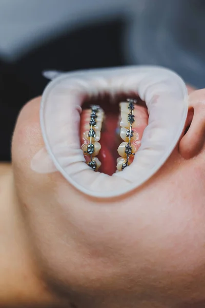 Ortodontyczne Leczenie Zębów Zbliżenie Żeńskich Zębów Aparatem Zęby Lekarz Instaluje — Zdjęcie stockowe