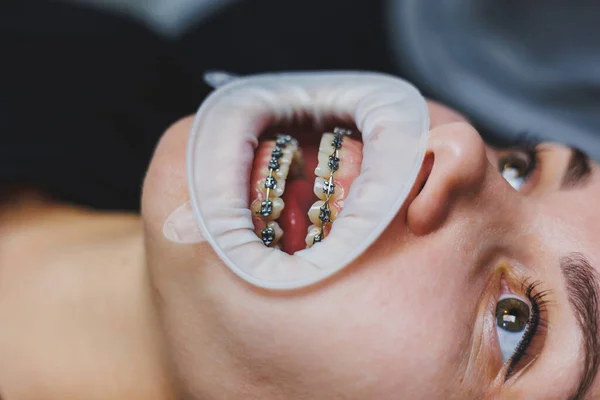 Orthodontic treatment of teeth. Close-up of female teeth with braces. The doctor installs metal braces on the patient's teeth. Oral care. Selective focus