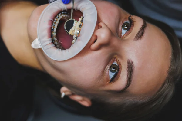 Ортодонтическое Лечение Зубов Крупный План Женских Зубов Брекетами Врач Устанавливает — стоковое фото