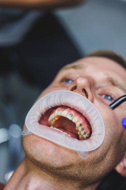 Diş tedavisiyle. Dişçiyle randevusu olan genç bir adam. Doktor dişlere metal diş telleri takıyor. Diş telleriyle yakın plan.