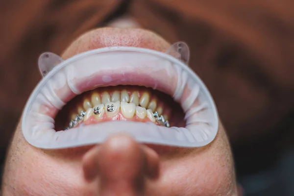Stomatologiczne Leczenie Zębów Młody Mężczyzna Wizycie Dentysty Lekarz Instaluje Metalowe — Zdjęcie stockowe