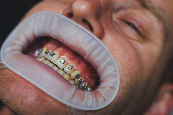Стоматологічне Лікування Зубів Молодий Чоловік Призначенням Стоматолога Лікар Встановлює Металеві — стокове фото
