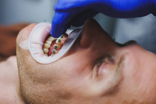 歯の歯科治療 歯医者の予約で若い男 医者は歯に金属のブレースを取り付けます ブレースで歯を閉じる — ストック写真