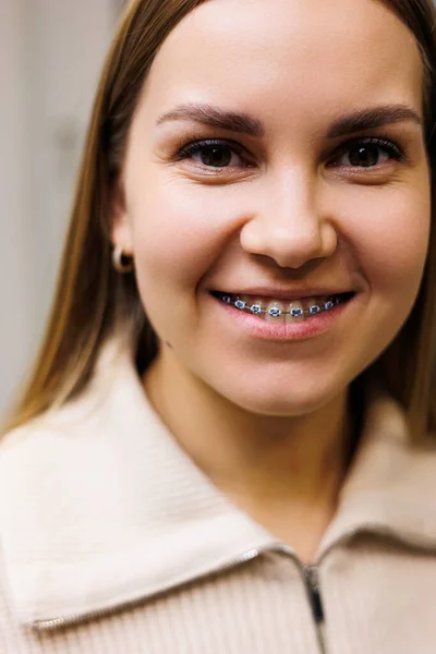 stock image Close-up of a woman's face with braces on her teeth. Orthodontic treatment of teeth