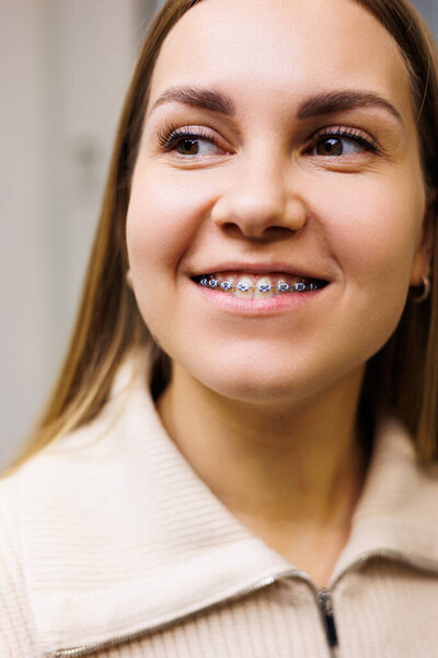 Close-up of a woman's face with braces on her teeth. Orthodontic treatment of teeth