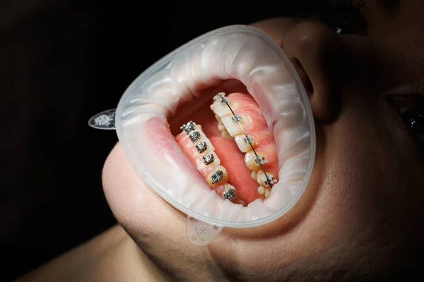 Крупним Планом Зуби Металевими Брекетами Ортодонтичне Лікування Щелепи — стокове фото