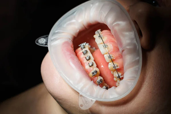 Zbliżenie Zębów Metalowymi Aparatami Zęby Leczenie Ortodontyczne Szczęki — Zdjęcie stockowe