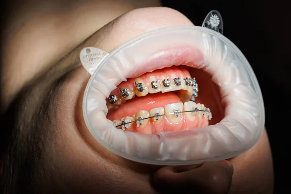 Крупним Планом Зуби Металевими Брекетами Ортодонтичне Лікування Щелепи — стокове фото