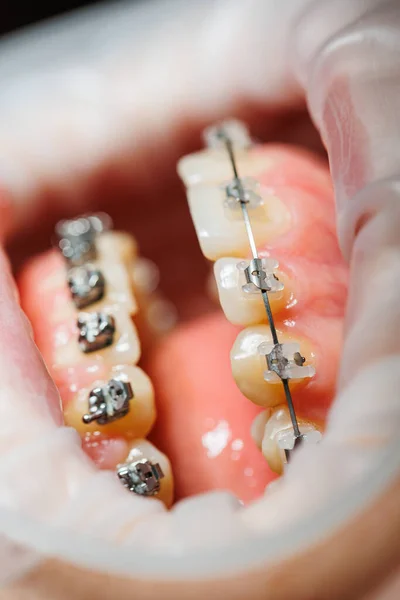 金属製のブレースで歯のクローズアップ 顎の矯正治療 — ストック写真