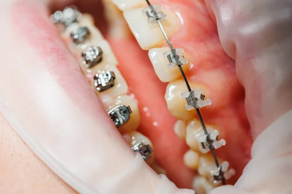 Nahaufnahme Von Zähnen Mit Metallspangen Kieferorthopädische Behandlung Des Kiefers — Stockfoto