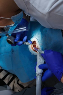 Kapalı diş tedavisi, diş tedavisi.