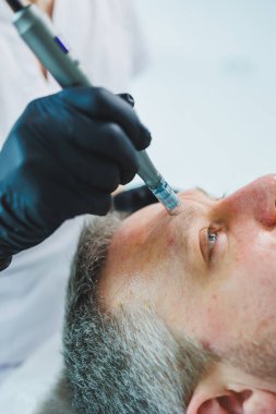 Güzellik uzmanı spa salonunda bir adamın yüzüne maske yapar. İşlem sırasında erkek yüzünün yan görüntüsü. Deride sivilceler ve sivilceler. Bir erkeğin yüzü için iğne