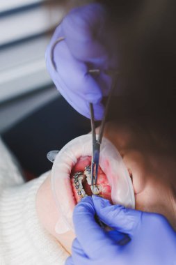 Ağız bakımı. Kadın dişlerinde diş teli sistemi. Dişleri hizalamak için diş telleri kurulumu.