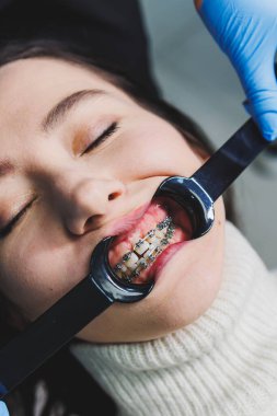 Ağız bakımı. Kadın dişlerinde diş teli sistemi. Dişleri hizalamak için diş telleri kurulumu.