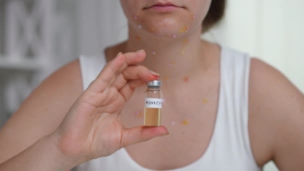 Ung Kvinna Med Utslag Reklam Apkoppsvaccin Inomhus Framifrån Oigenkännlig Vit — Stockvideo