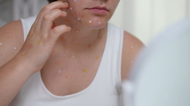 Mujer Arañando Sarpullido Viruela Cara Mirando Espejo Mano Irreconocible Joven — Vídeos de Stock