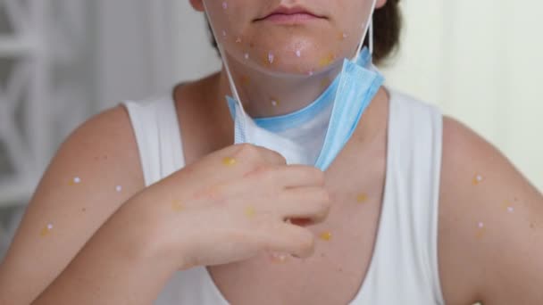 Mujer Con Erupción Cara Mostrando Dermatitis Por Varicela Joven Irreconocible — Vídeos de Stock