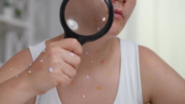 Unrecognizable Woman Showing Monkeypox Rash Magnifier Slow Motion Young Caucasian — Stock Video