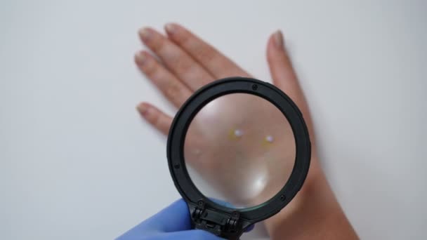 Visão Superior Analisando Exantema Varíola Com Lupa Câmera Lenta Mão — Vídeo de Stock