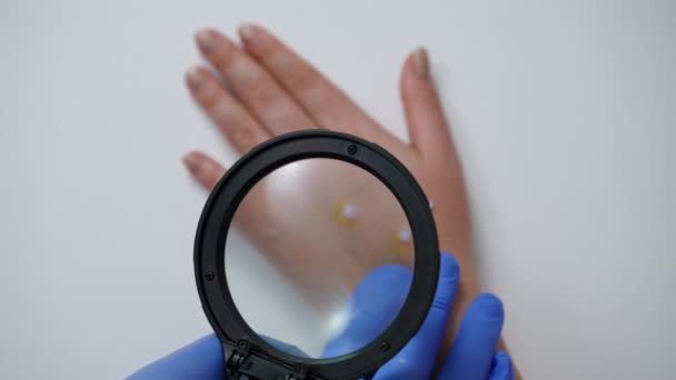 女性の手のひらにモンキー水痘発疹を調べる手袋で医師の手でトップビュールーペ 認識できない医師は 運動の閉鎖が遅い中で天然痘を持つ白人女性の症状を分析します — ストック動画
