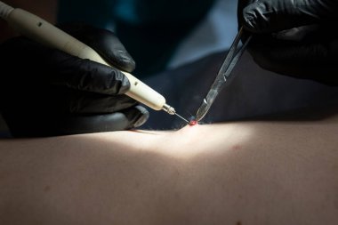 Doktor, ben aldırmak için ameliyat yapıyor.