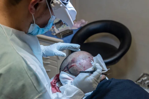Przeszczep Włosów Chirurdzy Sali Operacyjnej Przeprowadzają Operację Przeszczepu Włosów Obrazek Stockowy
