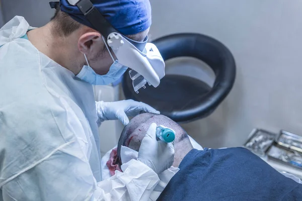 Hårtransplantation Kirurger Operationssalen Utför Hårtransplantationskirurgi Stockfoto