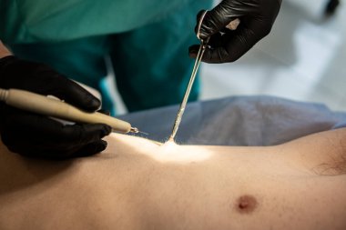 Doktor siğil temizliği yapıyor. Ayakta ameliyat