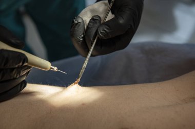 Doktor siğil temizliği yapıyor. Ayakta ameliyat