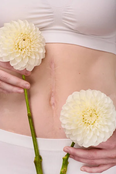Close-up of young woman with scar on her body holding beautiful flowers in front of her