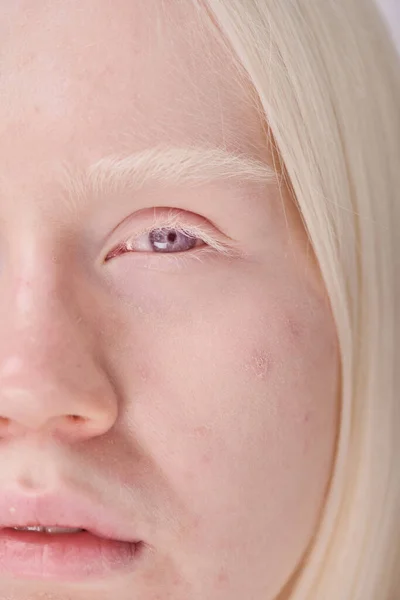Beyaz Saçlı Mavi Gözlü Kameraya Bakan Genç Albino Kızın Yakın — Stok fotoğraf