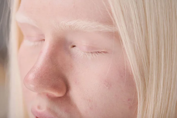 Close Van Jong Albino Meisje Met Natuurlijke Uitstraling Met Witte — Stockfoto