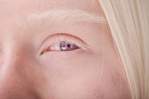 Крупный план молодого лица альбиноса с голубыми глазами и белыми ресницами