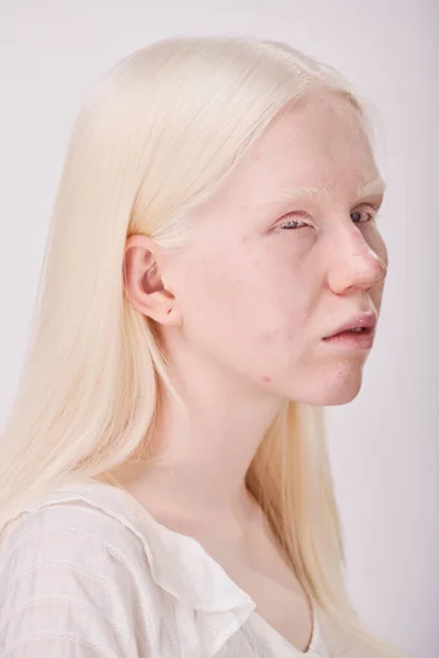 Πορτρέτο Της Νεαρής Γυναίκας Albino Ασυνήθιστη Εμφάνιση Απομονωμένη Λευκό Φόντο — Φωτογραφία Αρχείου