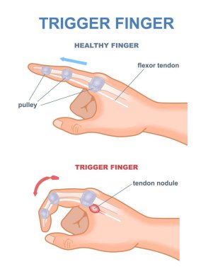 Tetik parmağı diyagramı. Eklemler bükülmüş durumda. Tendon anatomisi ve el işaret parmağı kemikleri. Tıbbi travma esnekliği tendonu, eğitim programının içerisinden. Çizgi film düz vektör çizimi