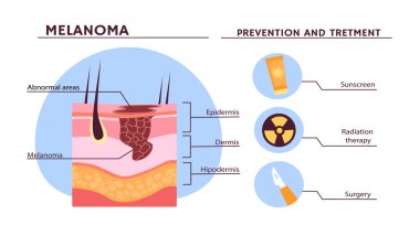 Melanoma konsepti. Hastalık ve hastalık hakkında eğitici tıbbi materyaller. Önleme ve koruma hakkında tavsiyeler. Sağlık ve tedavi hizmetleri. Çizgi film düz vektör çizimi