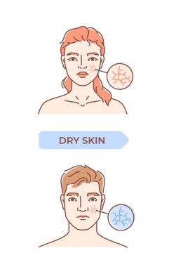 Deri durumu bilgi grafikleri. Kuru ciltli kadın ve erkek. Derma problemleri ve hastalıklar. Anatomi ve biyoloji. Deri bakımı konsepti. Beyaz arkaplanda izole edilmiş doğrusal vektör çizimi
